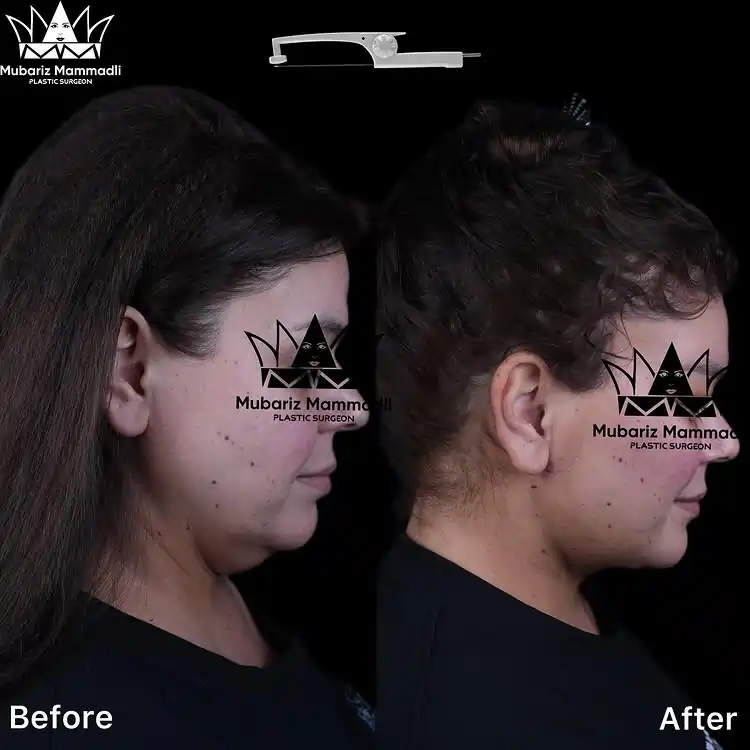 Neck Lift before and after Neck Lift surgeries before after