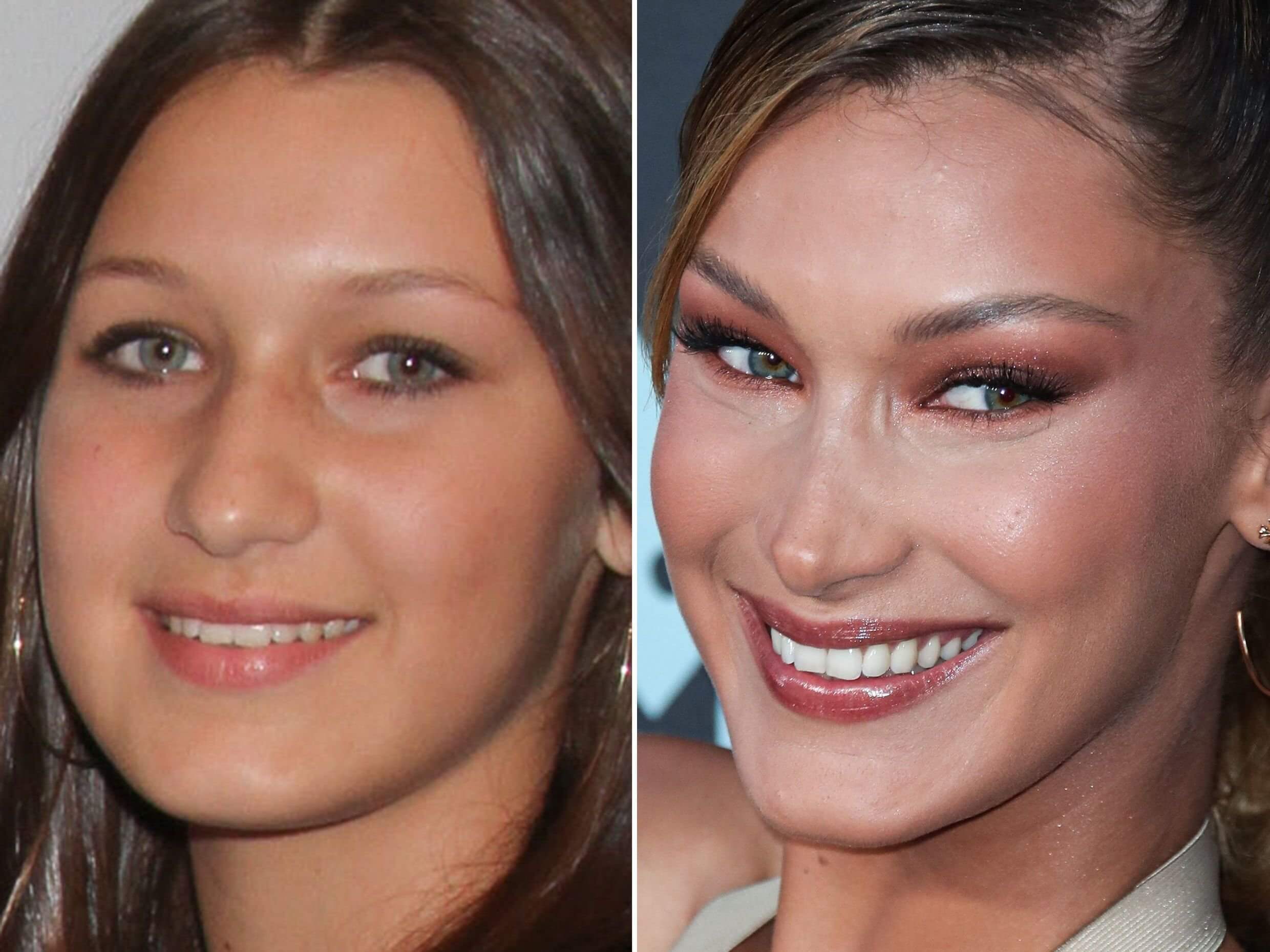 Discover Bella Hadid's before-and-after transformation. Confirmed  rhinoplasty, plus expert insights into rumored cosmetic procedures., image size:2480x1860